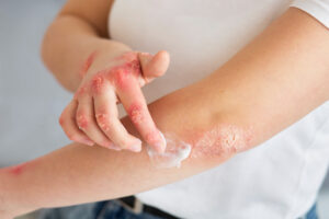 psoriasis behandlung