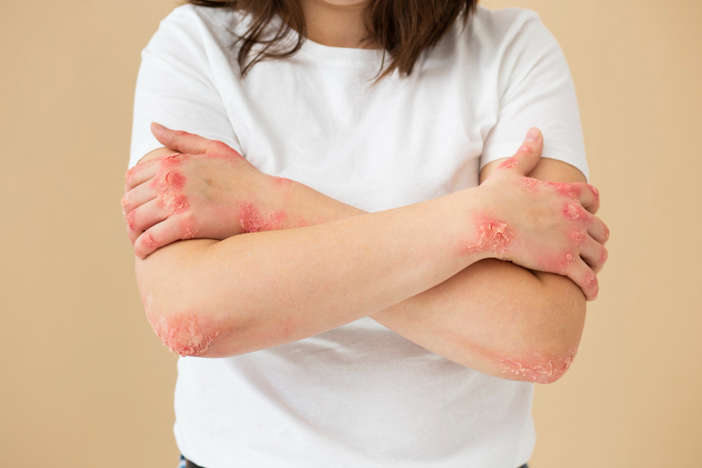 psoriasis