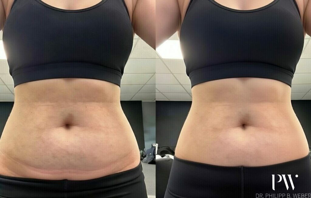 Fett Weg Spritze Vorher Nachher Bauch